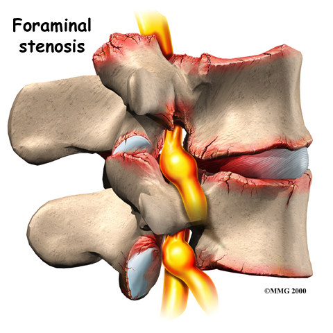 Forminal stenosis