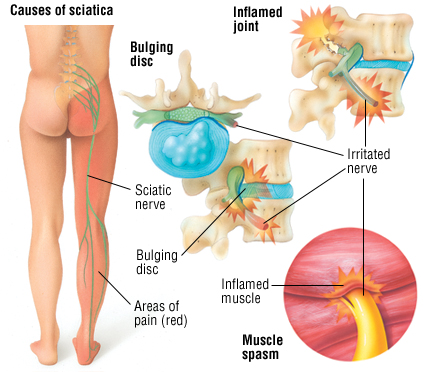 Sciatic pain causes and solutions during sleep - Orthex
