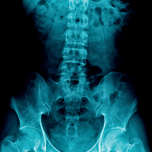 Spinal Cord Stimulator Implant in Plano, Frisco, McKinney and Allen